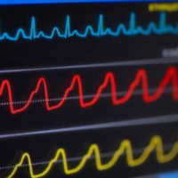 Shortness of breath and rapid heartbeat (tachycardia)?