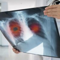 Lung cancer: is there a natural treatment?
