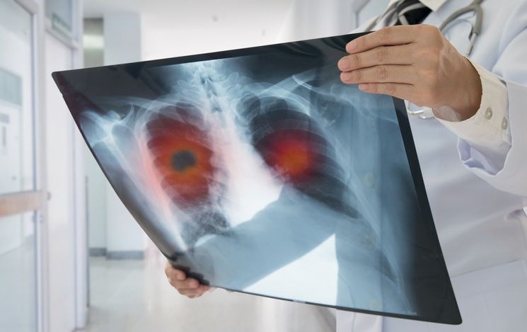 Lung cancer is there a natural treatment