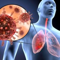 Lung infection: a guide to this disease