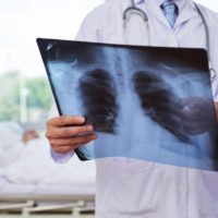 Pneumonia: guide to this acute respiratory infection